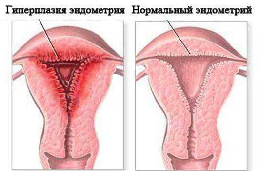 Народное лечение гиперплазии эндометрия травой ортилия однобокая