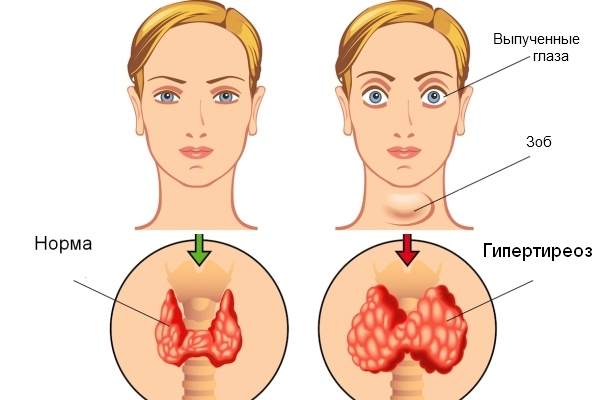 Selenio y tiroides